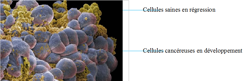 Vue microscopique- Carcinome du sein