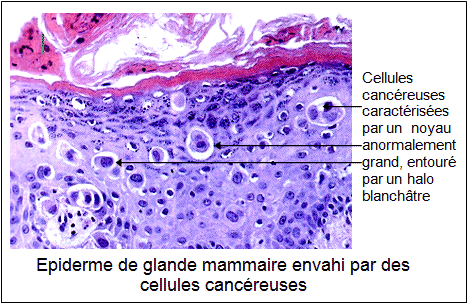epiderme de glande mamaire envahi par des cellules cancéreuses