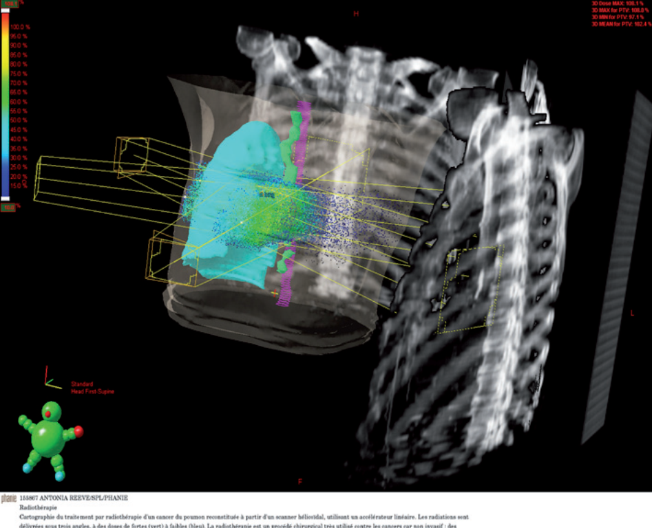 Cartographie de traitement par radiothérapie d’un cancer du poumon reconstituée à partir d’un scanner.